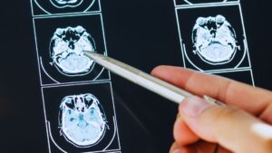 A hand pointing with a pen at brain scan images on a screen, illustrating the medical proof for a brain injury settlement.