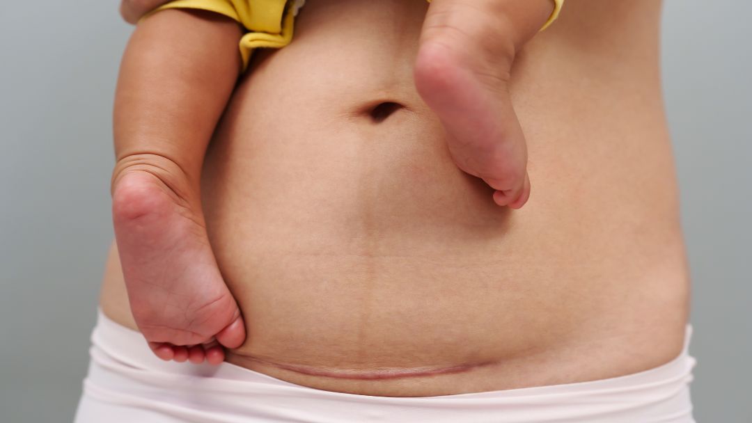 A close-up of a person's abdomen showing a cesarean section scar (C-section scar) below the navel, while they hold an infant whose legs and feet are visible.